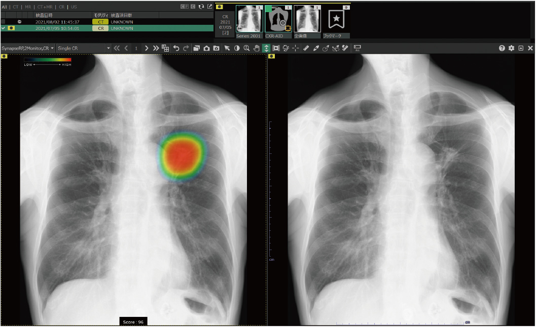 胸部X線画像病変検出ソフトウェア